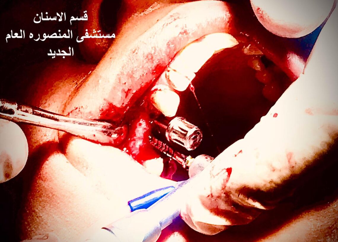 إجراء أول عملية زراعة أسنان بمستشفى المنصورة الدولى 19 - جريدة المساء