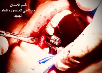 إجراء أول عملية زراعة أسنان بمستشفى المنصورة الدولى 28 - جريدة المساء