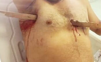 فريق طبى ينجح فى استخراج "قطعة خشب" من صدر مريض بكفر الشيخ 16 - جريدة المساء