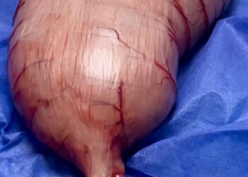 إنقاذ حياة طفل بإستئصال جزء من القولون بالاسكندرية 29 - جريدة المساء