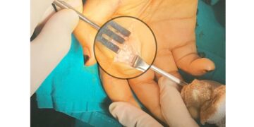 إستئصال حصوة من القناة المرارية بالمنظار فى مستشفى كتشنر 9 - جريدة المساء