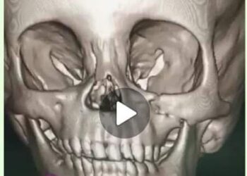إجراء عملية دقيقة لإصلاح كسور متعددة .. لأول مرة بمستشفيات محافظة البحر الاحمر 19 - جريدة المساء