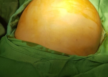 استئصال ورمين بالكبد لطفلين بالاسكندرية 26 - جريدة المساء