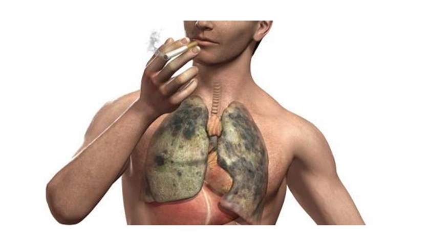 صندوق مكافحة الإدمان محذراً: التدخين يسبب سرطان الرئة والإصابة بالسكتة الدماغية 18 - جريدة المساء أضرار سرطانية بسبب التدخين