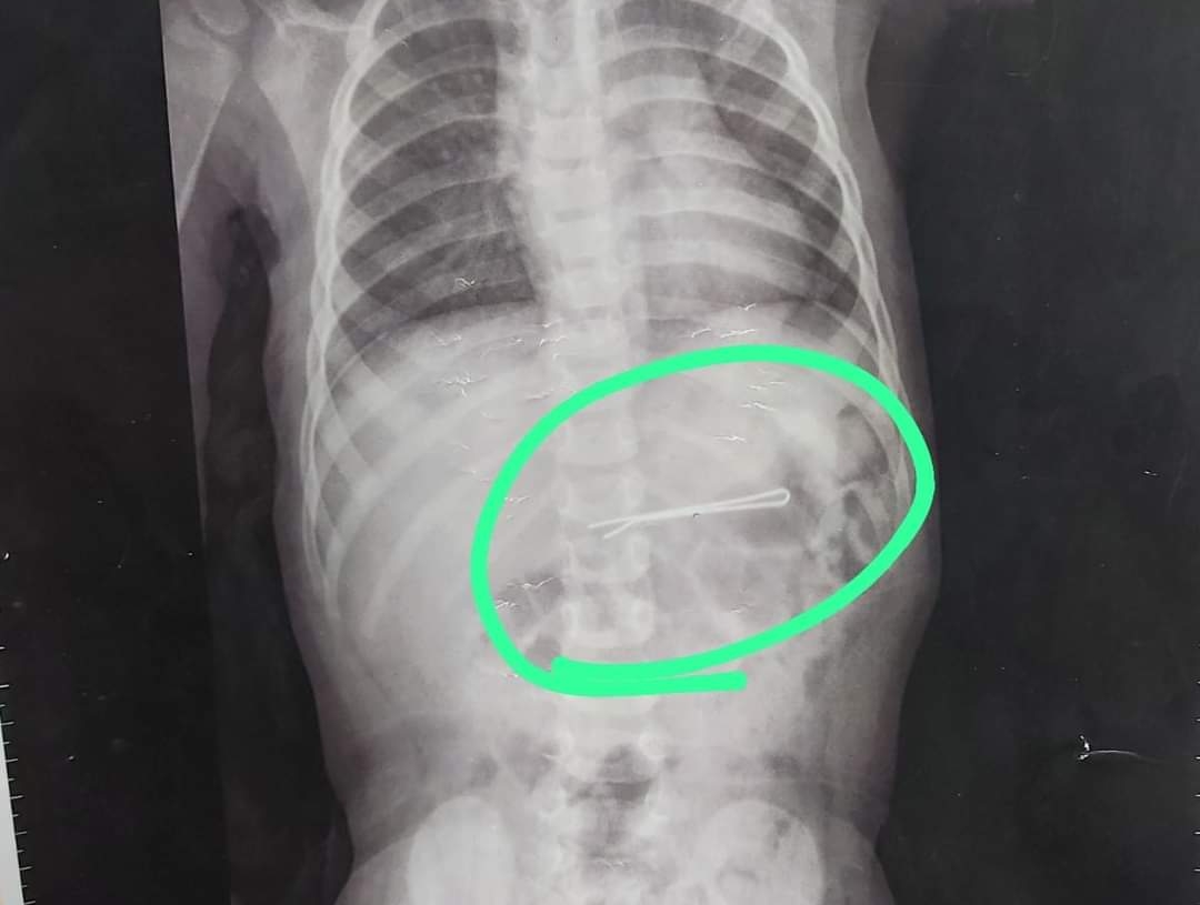 بالصور.. استخراج "بنسه شعر" من بطن طلفه بالشرقية بعد ابتلاعها 39 - جريدة المساء