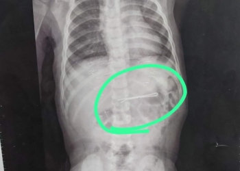 بالصور.. استخراج "بنسه شعر" من بطن طلفه بالشرقية بعد ابتلاعها 31 - جريدة المساء