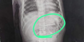 بالصور.. استخراج "بنسه شعر" من بطن طلفه بالشرقية بعد ابتلاعها 21 - جريدة المساء