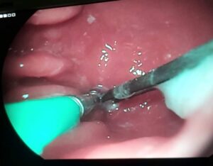 بالصور.. استخراج "بنسه شعر" من بطن طلفه بالشرقية بعد ابتلاعها 45 - جريدة المساء