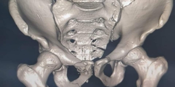 صحة الشرقية: لأول مرة.. إجراء عملية متقدمة لتثبيت كسر في الحوض والمفصل العجزي الحرقفي 1 - جريدة المساء