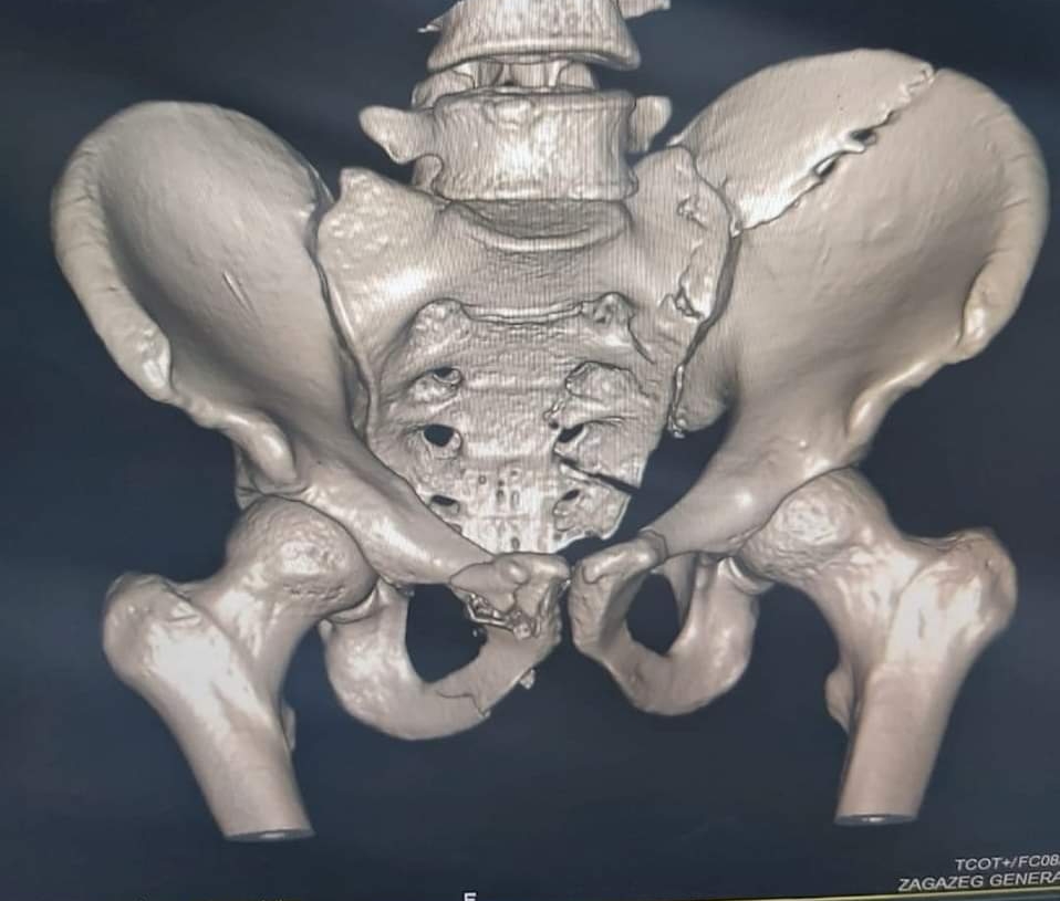 صحة الشرقية: لأول مرة.. إجراء عملية متقدمة لتثبيت كسر في الحوض والمفصل العجزي الحرقفي 19 - جريدة المساء