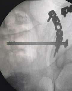 صحة الشرقية: لأول مرة.. إجراء عملية متقدمة لتثبيت كسر في الحوض والمفصل العجزي الحرقفي 21 - جريدة المساء