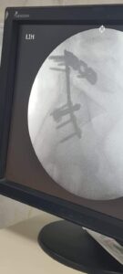 صحة الشرقية: لأول مرة.. إجراء عملية متقدمة لتثبيت كسر في الحوض والمفصل العجزي الحرقفي 27 - جريدة المساء