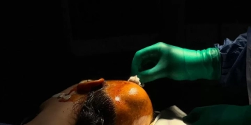 الصحة: جراحة متطورة تعيد الشكل الطبيعي لجمجمة فتاة باستخدام تقنية الطباعة ثلاثية الأبعاد 2 - جريدة المساء الصحة: جراحة متطورة تعيد الشكل الطبيعي لجمجمة فتاة باستخدام تقنية الطباعة ثلاثية الأبعاد 1 - جريدة المساء