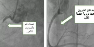 تدخل طبي عاجل ينقذ شابًا من جلطة قلبية حادة بمستشفى بني سويف التخصصي 1 - جريدة المساء