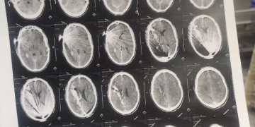 قسم جراحة المخ والأعصاب يجري عملية جراحية دقيقة لمصاب بطلق ناري في الرأس 2 - جريدة المساء قسم جراحة المخ والأعصاب يجري عملية جراحية دقيقة لمصاب بطلق ناري في الرأس 1 - جريدة المساء