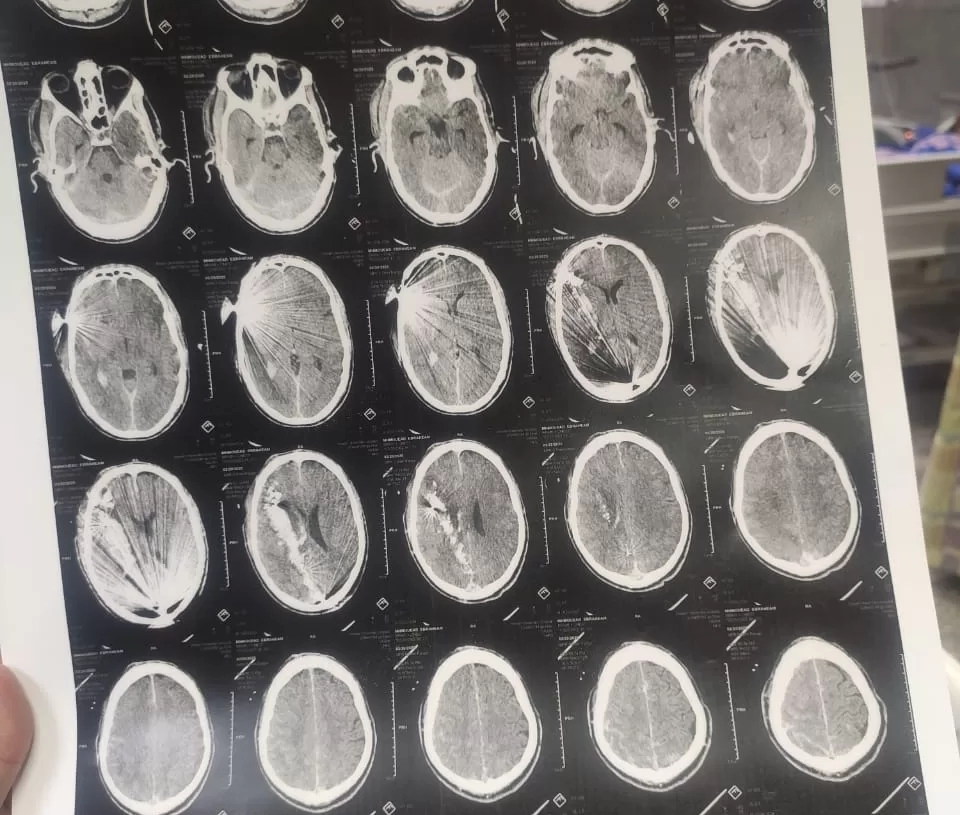 قسم جراحة المخ والأعصاب يجري عملية جراحية دقيقة لمصاب بطلق ناري في الرأس 20 - جريدة المساء قسم جراحة المخ والأعصاب يجري عملية جراحية دقيقة لمصاب بطلق ناري في الرأس 19 - جريدة المساء