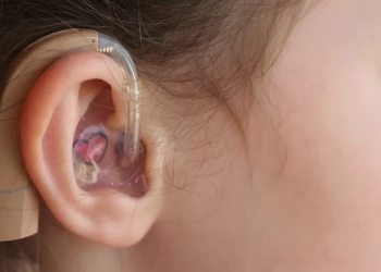 تركيب سماعات لضعاف السمع