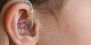 73 مركزًا لغويًا و6 مؤسسات: جهود مكثفة لتأهيل الصم وضعاف السمع في مصر 1 - جريدة المساء تركيب سماعات لضعاف السمع