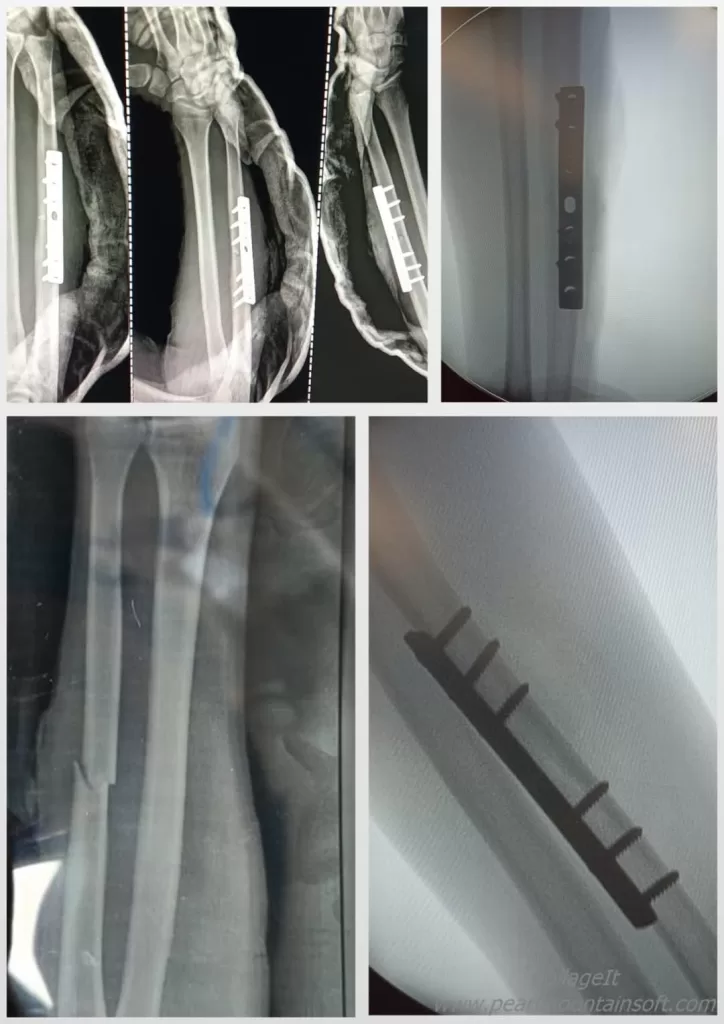 تشغيل قسم جراحة العظام والمفاصل بمستشفى العدوة المركزي لتقديم الخدمة الطبية لأهالي شمال الصعيد 21 - جريدة المساء