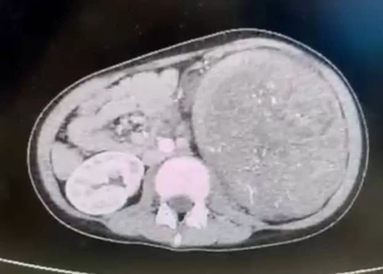 "بين الحياة والموت" … لحظة حسمها فريق الجراحة ب " الباجور التخصصى" باستئصال الكلية اليسرى و ورم وغدد ليمفاوية لطفلة 33 - جريدة المساء