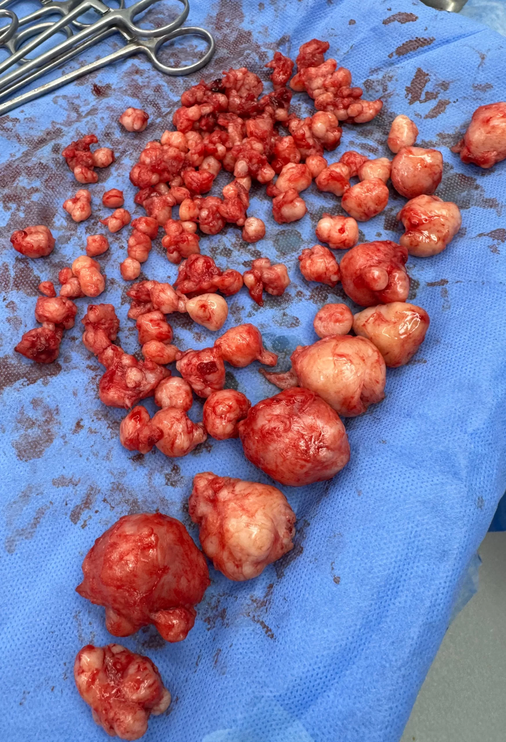 طبيب مصري ينجح في استئصال 121 ورمًا ليفيًا من رحم شابة سودانية دون استئصاله 23 - جريدة المساء