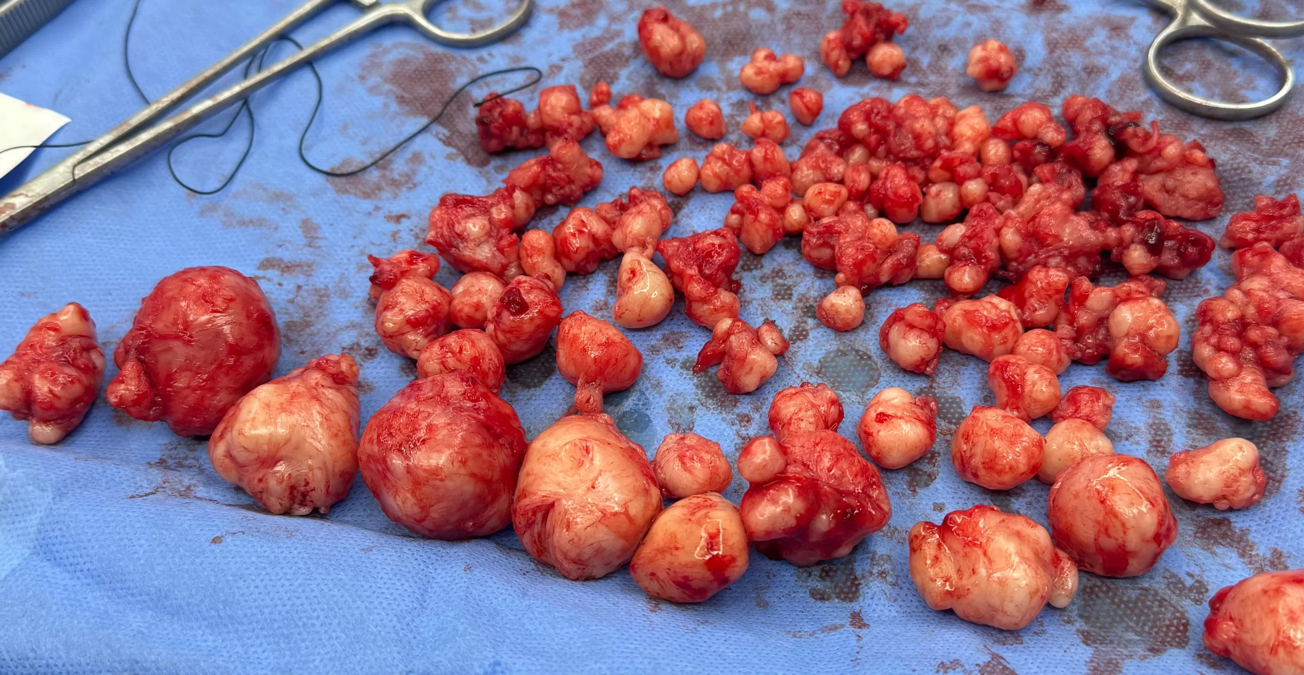 طبيب مصري ينجح في استئصال 121 ورمًا ليفيًا من رحم شابة سودانية دون استئصاله 25 - جريدة المساء