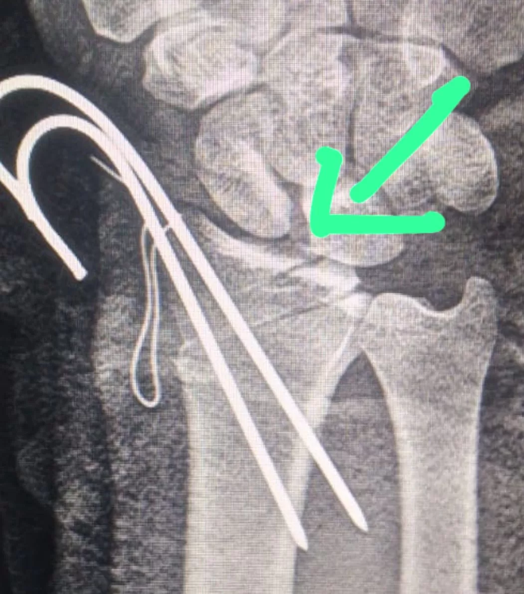 إنجاز طبي بمستشفى السنبلاوين: إنقاذ يد مريض من البتر في جراحة دقيقة 21 - جريدة المساء