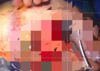 أطباء سوهاج الجامعي ينقذون شابًا من موت محقق بعد إصابته بطعنة قاتلة في القلب والرئة 23 - جريدة المساء