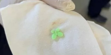 استخراج “توكه بلاستيك” من رئة مريض بمستشفى صدر العباسية 1 - جريدة المساء