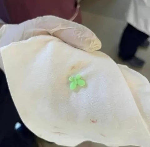 استخراج “توكه بلاستيك” من رئة مريض بمستشفى صدر العباسية 18 - جريدة المساء