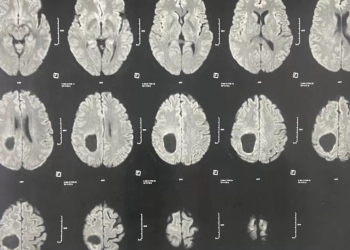 نجاح جراحة ميكروسكوبية دقيقة لاستئصال ورم بالمخ بمستشفى سوهاج الجامعي 35 - جريدة المساء