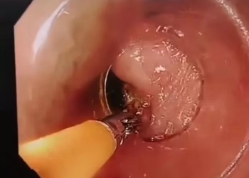 مستشفي العلمين ينجح في استخراج عظمة دجاجة علقت في مريء شاب  17 - جريدة المساء