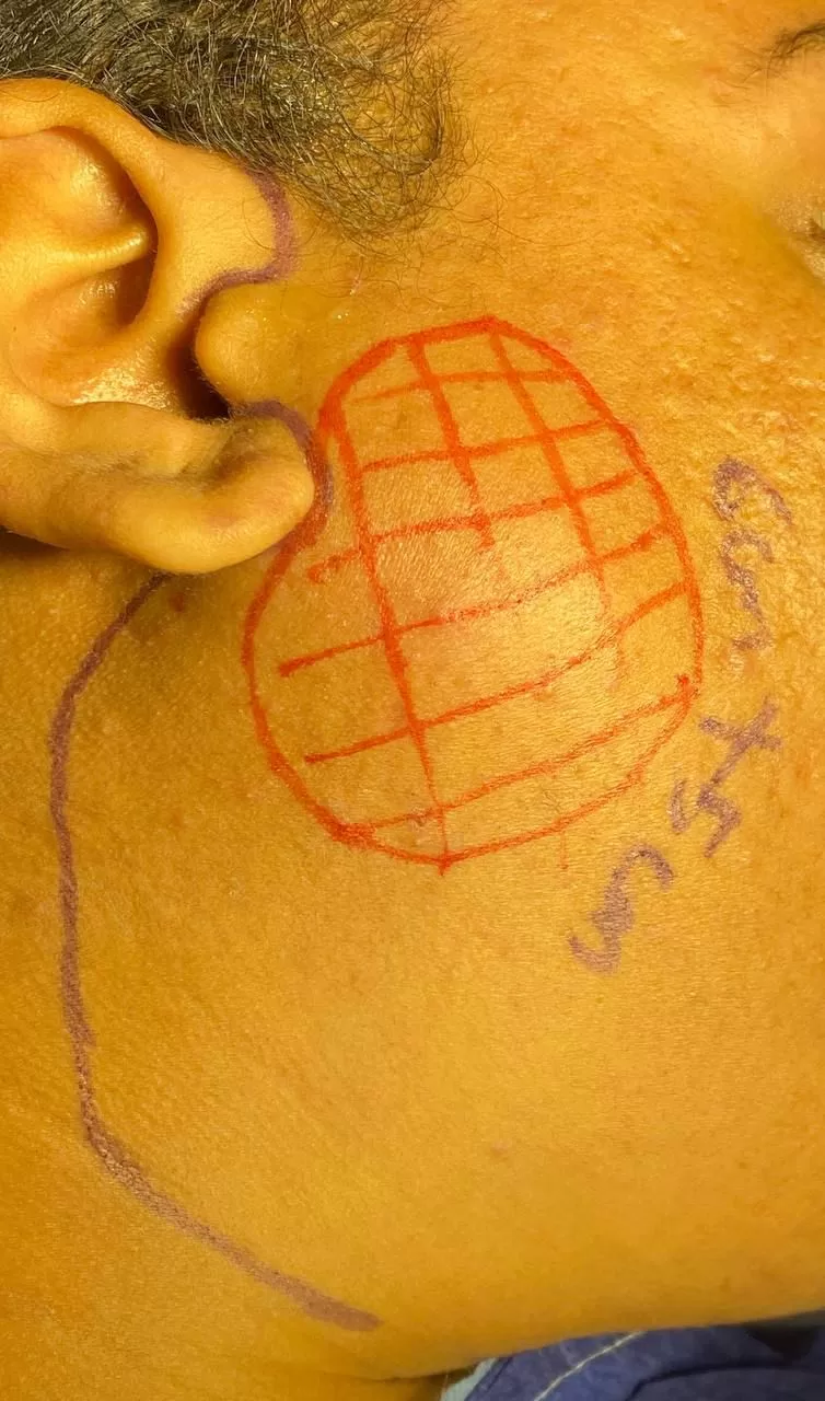 جراحة دقيقة بمستشفى قنا العام تنقذ مريضة من ورم نادر بالغدة النكافية دون المساس بأعصاب الوجه 23 - جريدة المساء