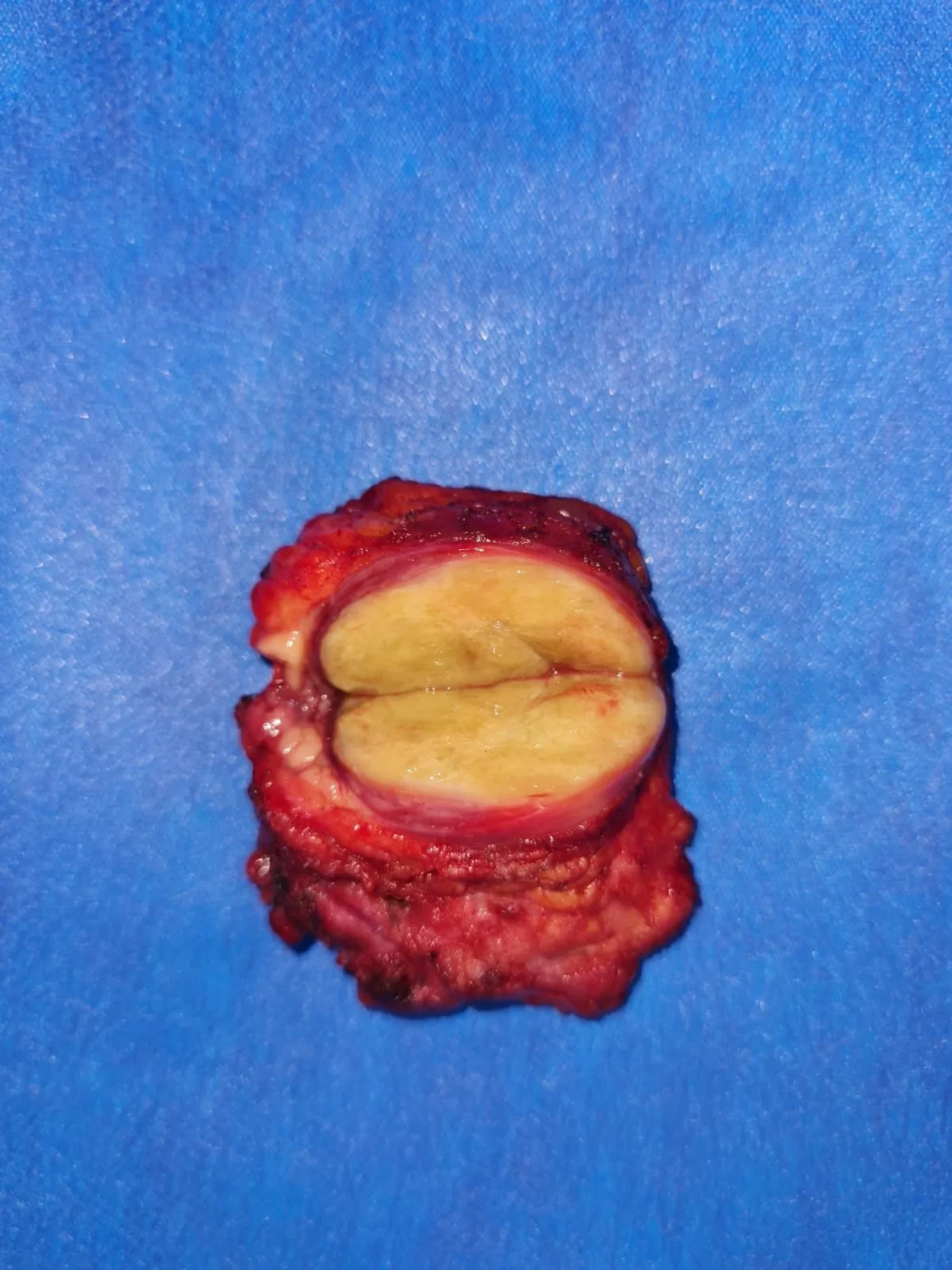 جراحة دقيقة بمستشفى قنا العام تنقذ مريضة من ورم نادر بالغدة النكافية دون المساس بأعصاب الوجه 27 - جريدة المساء