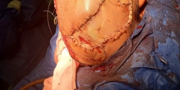 إنقاذ شاب بحادث سير وإجراء جراحة معقدة بمستشفى الشيخ زايد التخصصي 1 - جريدة المساء