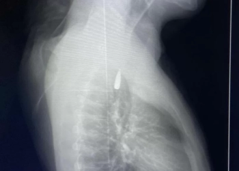 إنجاز طبي جديد بجامعة الإسكندرية لإنقاذ مصاب فلسطيني من قطاع غزة 35 - جريدة المساء