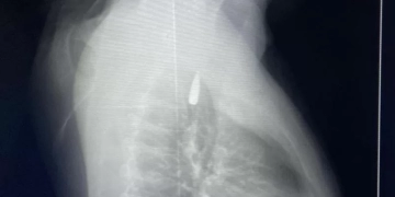 إنجاز طبي جديد بجامعة الإسكندرية لإنقاذ مصاب فلسطيني من قطاع غزة 2 - جريدة المساء إنجاز طبي جديد بجامعة الإسكندرية لإنقاذ مصاب فلسطيني من قطاع غزة 1 - جريدة المساء