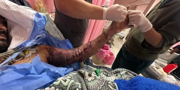 فريق سوهاج الجامعي ينجح في إنقاذ طرفين بعمليات ميكروسكوبية معقدة 1 - جريدة المساء