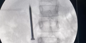 فريق طبى بمعهد كبد المنوفية ينقذ طفلة من الموت.. استخرج مسمارا من أمعائها في 20 دقيقة 1 - جريدة المساء