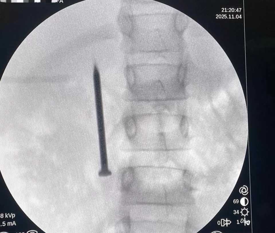 فريق طبى بمعهد كبد المنوفية ينقذ طفلة من الموت.. استخرج مسمارا من أمعائها في 20 دقيقة 19 - جريدة المساء
