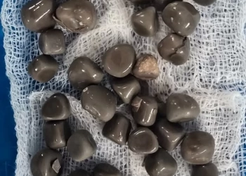 استخراج 58 حصوة من كلية مريض أربعيني في عملية دقيقة بمستشفى قنا الجامعي 28 - جريدة المساء استخراج 58 حصوة من كلية مريض أربعيني في عملية دقيقة بمستشفى قنا الجامعي 27 - جريدة المساء