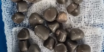 استخراج 58 حصوة من كلية مريض أربعيني في عملية دقيقة بمستشفى قنا الجامعي 1 - جريدة المساء