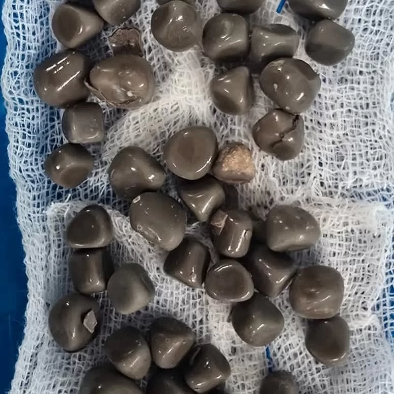 استخراج 58 حصوة من كلية مريض أربعيني في عملية دقيقة بمستشفى قنا الجامعي 19 - جريدة المساء