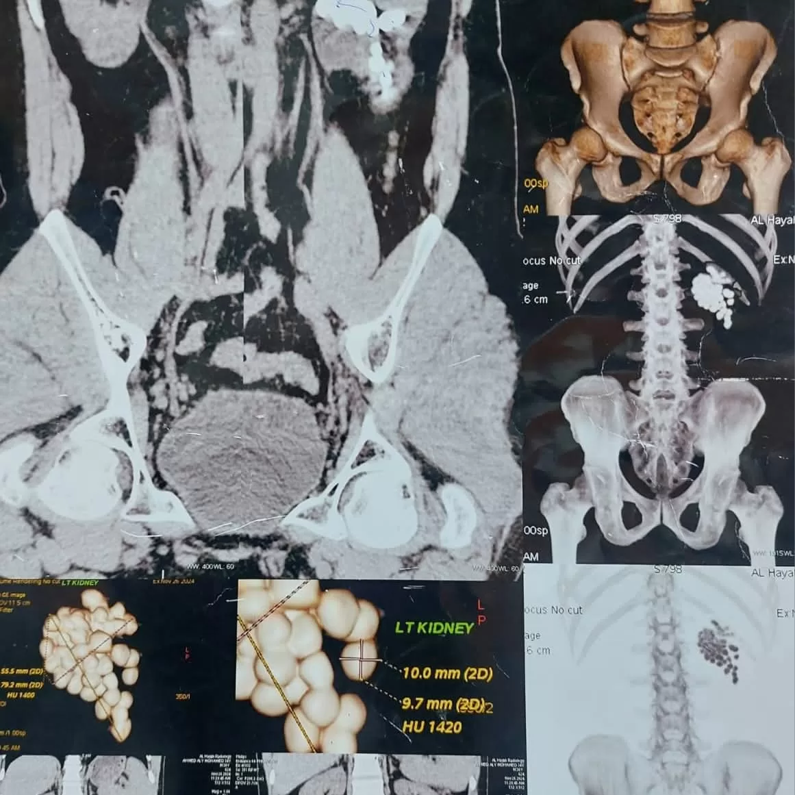استخراج 58 حصوة من كلية مريض أربعيني في عملية دقيقة بمستشفى قنا الجامعي 27 - جريدة المساء