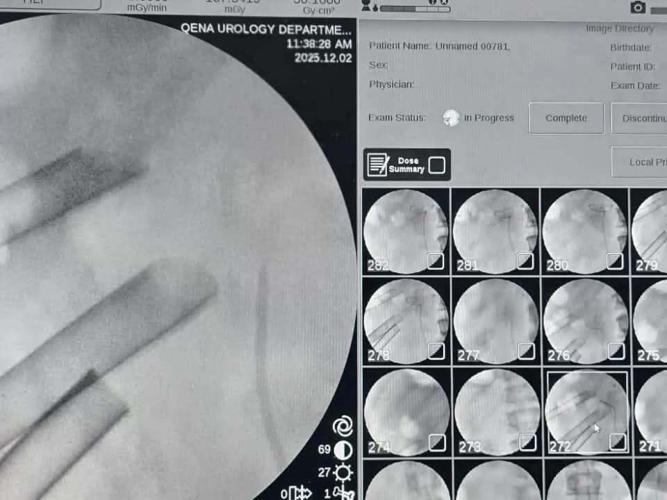 استخراج 58 حصوة من كلية مريض أربعيني في عملية دقيقة بمستشفى قنا الجامعي 29 - جريدة المساء