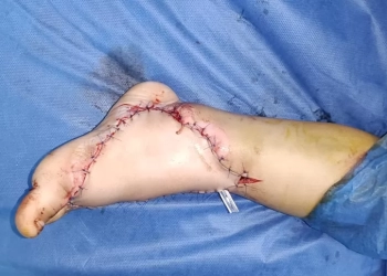 مستشفي الشيخ زايد التخصصي..نجح في إجراء جراحة ميكروسكوبية دقيقة ومعقدة لإنقاذ قدم طفل بعمر ٣ سنوات  إثر تعرضه لحادث سير 25 - جريدة المساء