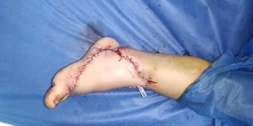 نجاح جراحة ميكروسكوبية دقيقة لانقاذ طفل من بتر ساقه بـ "زايد التخصصي" 2 - جريدة المساء نجاح جراحة ميكروسكوبية دقيقة لانقاذ طفل من بتر ساقه بـ "زايد التخصصي" 1 - جريدة المساء