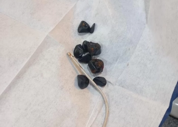 نجاح جراحة دقيقة لسيدة سبعينية بمستشفى قنا العام لاستخراج دعامة مرارية مهاجرة 20 - جريدة المساء