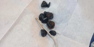 نجاح جراحة دقيقة لسيدة سبعينية بمستشفى قنا العام لاستخراج دعامة مرارية مهاجرة 1 - جريدة المساء