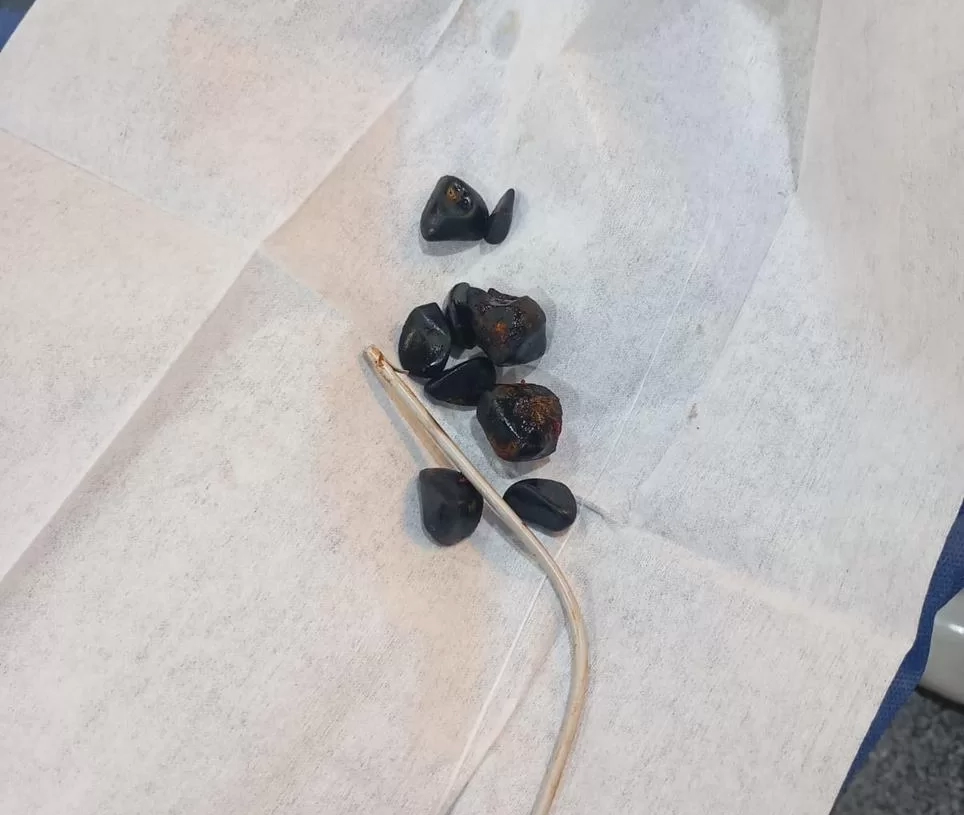 نجاح جراحة دقيقة لسيدة سبعينية بمستشفى قنا العام لاستخراج دعامة مرارية مهاجرة 17 - جريدة المساء